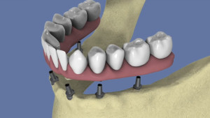 Mandibule complète et traitement implantaire pour un bridge fixe scellé